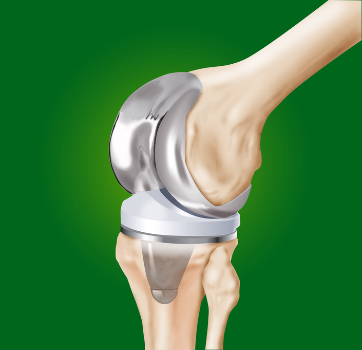 Knieprothese als vollständiger Gelenkersatz