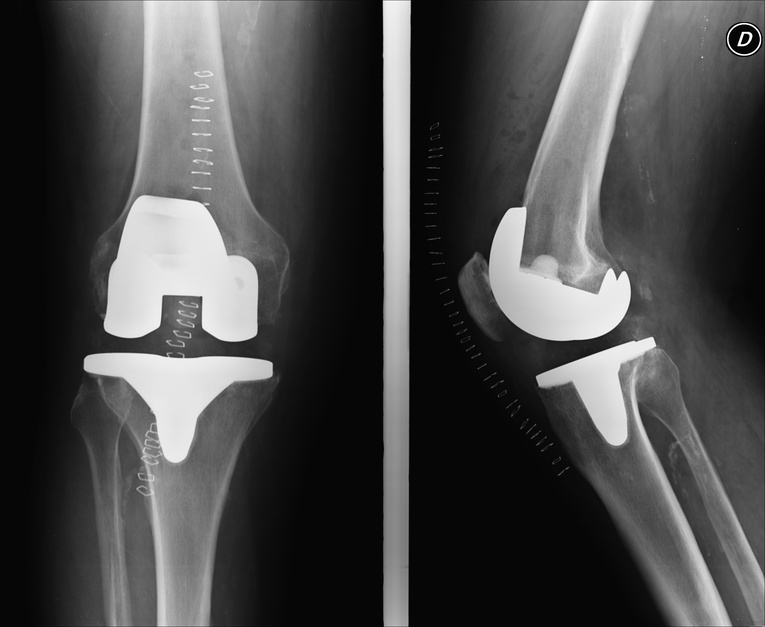 Knieprothese schlitten - Die TOP Favoriten unter der Vielzahl an Knieprothese schlitten!