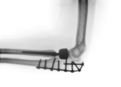 Röntgenbild einer Ellenbogenprothese