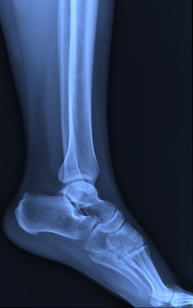 X-ray ankle joint.