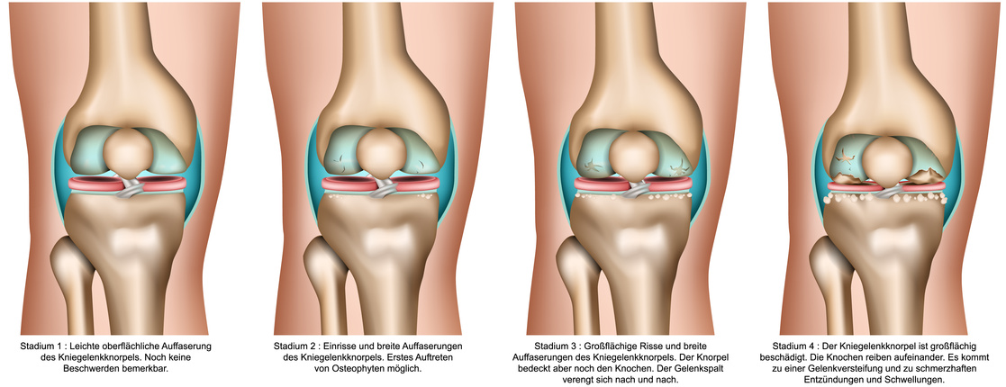 Stadien der Kniegelenksarthrose
