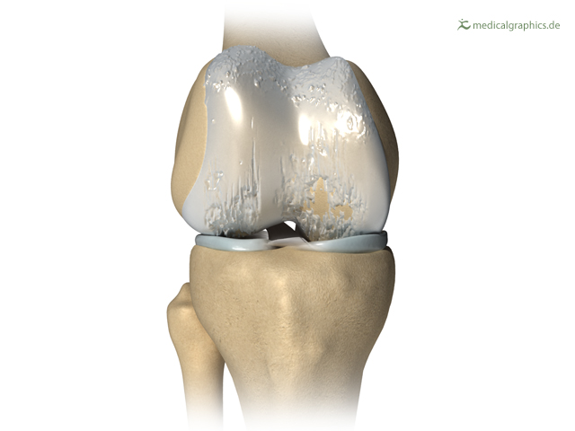 Schmerzmittel Arthrose Knie