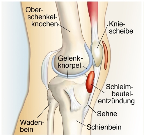 Schleimbeutelentzündung Knie